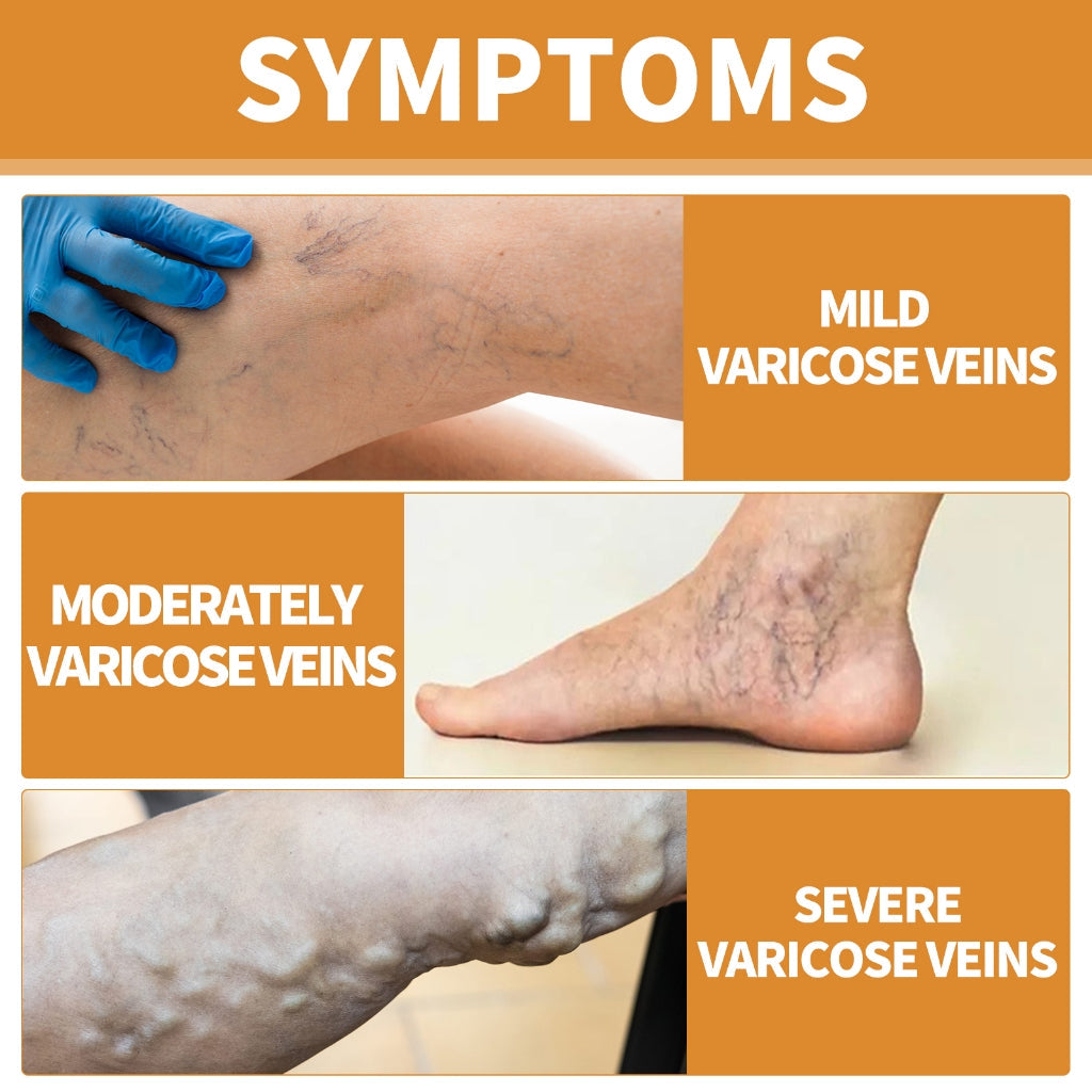 Varicose Vein Relief Spray (Buy 1 Get 2 Free 😍)