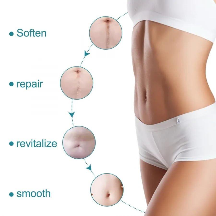 Silicone Scar Remover Tape for Acne & Wrinkles