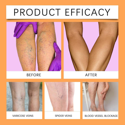 Varicose Vein Relief Spray (Buy 1 Get 2 Free 😍)