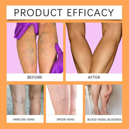 Varicose Vein Relief Spray (Buy 1 Get 2 Free 😍)